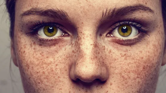 Hautprobleme – Pigmentflecken ade