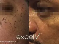 Altiderm