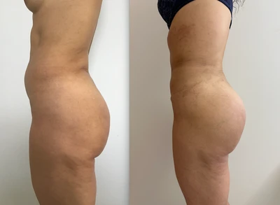 Gluteoplastica e liposuzione addome