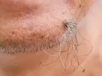 Altiderm
