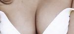 Augmentation mammaire - chirurgie esthétique des seins
