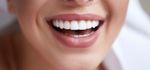 Veneers