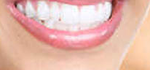 Le blanchiment des dents