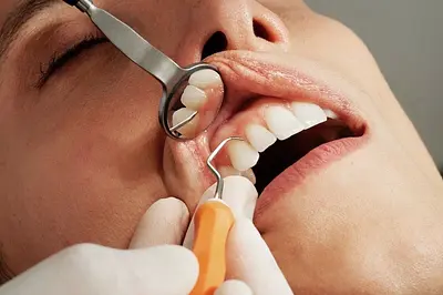 trattamento parodontale non chirurgico