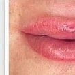 pigmentation des lèvres (photo juste après le soin, le resultaz deviendra naturel))