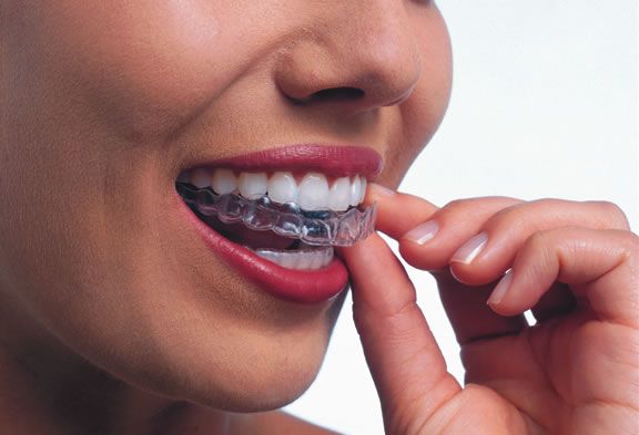 INVISALIGN