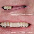 Implants dentaires et couronnes céramiques AVANT - APRES