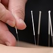 acupuncture et médecine chinoise