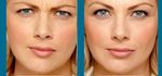 BOTULINO / BOTOX