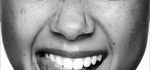 Blanchiment dentaire