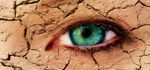Behandlung bei trockenen Augen (Siccasyndrom)