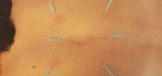 Triggerpunktbehandlungen und Dry Needling