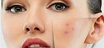 Akne- Narben und unreine Haut