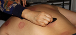 TUINA / GUA SHA