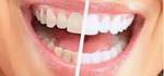 Blanchiment des dents