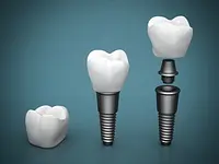 Naturlife Dental Mendrisio - Dr. Bontempelli Lorenzo - cliccare per ingrandire l’immagine 6 in una lightbox