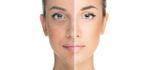 Cosmelan Peel Depigmentierung
