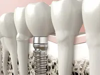 Praxis für Oralchirurgie und Implantologie Zürich Dr. Georg Damerau - Klicken Sie, um das Bild 6 in einer Lightbox vergrössert darzustellen