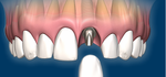 Implant dentaire