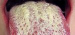 Traitement Candida Albicans