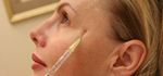 IL FILLER ALGENESS E QUELLI ALL'AC)DO IALURONICO