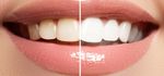 Bleaching