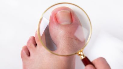 Ein Nietnagel Ist Nicht Nur Ein Kosmetisches Problem