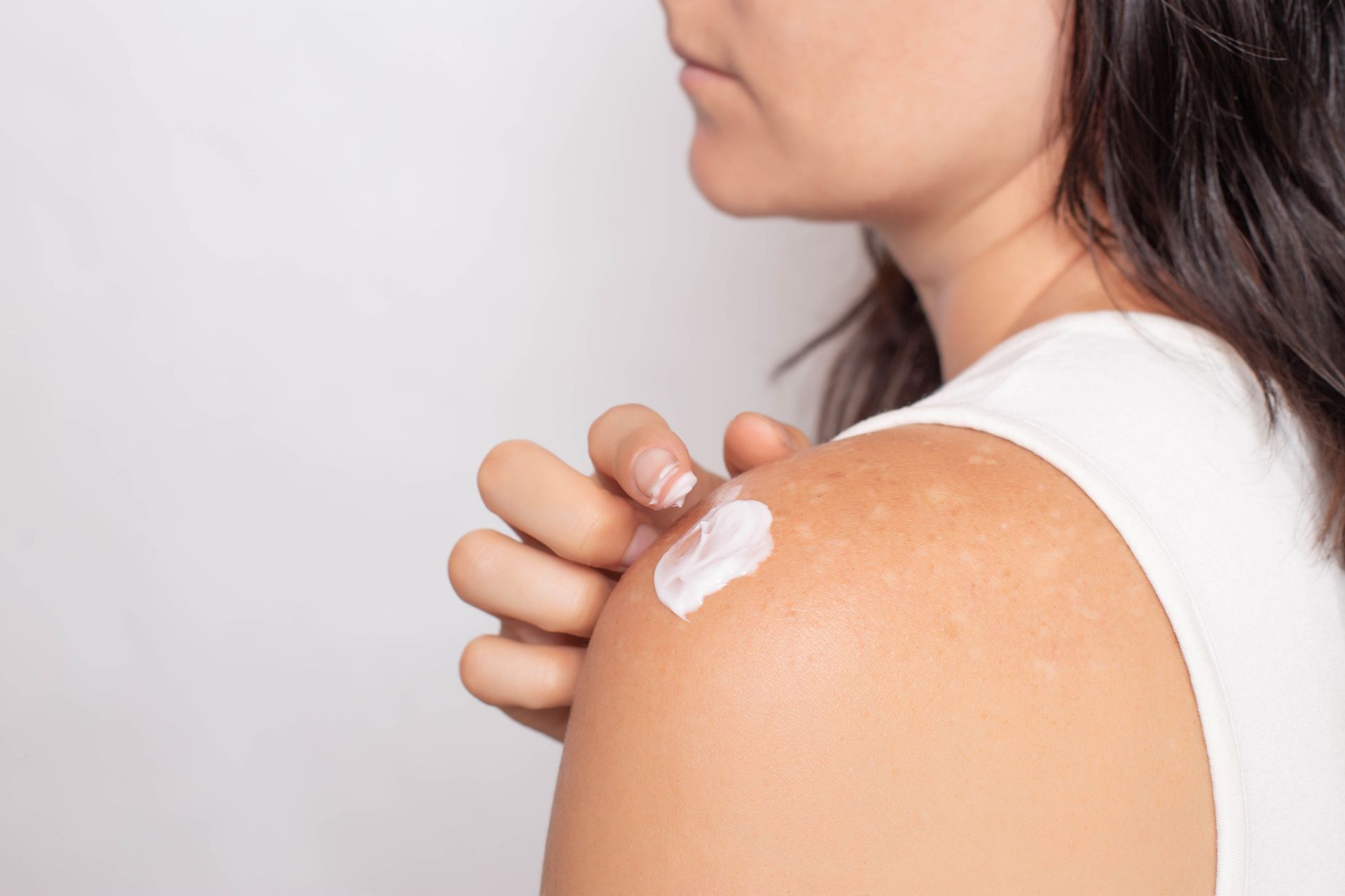 Pigmentstorung Der Hautarzt Kann Helfen