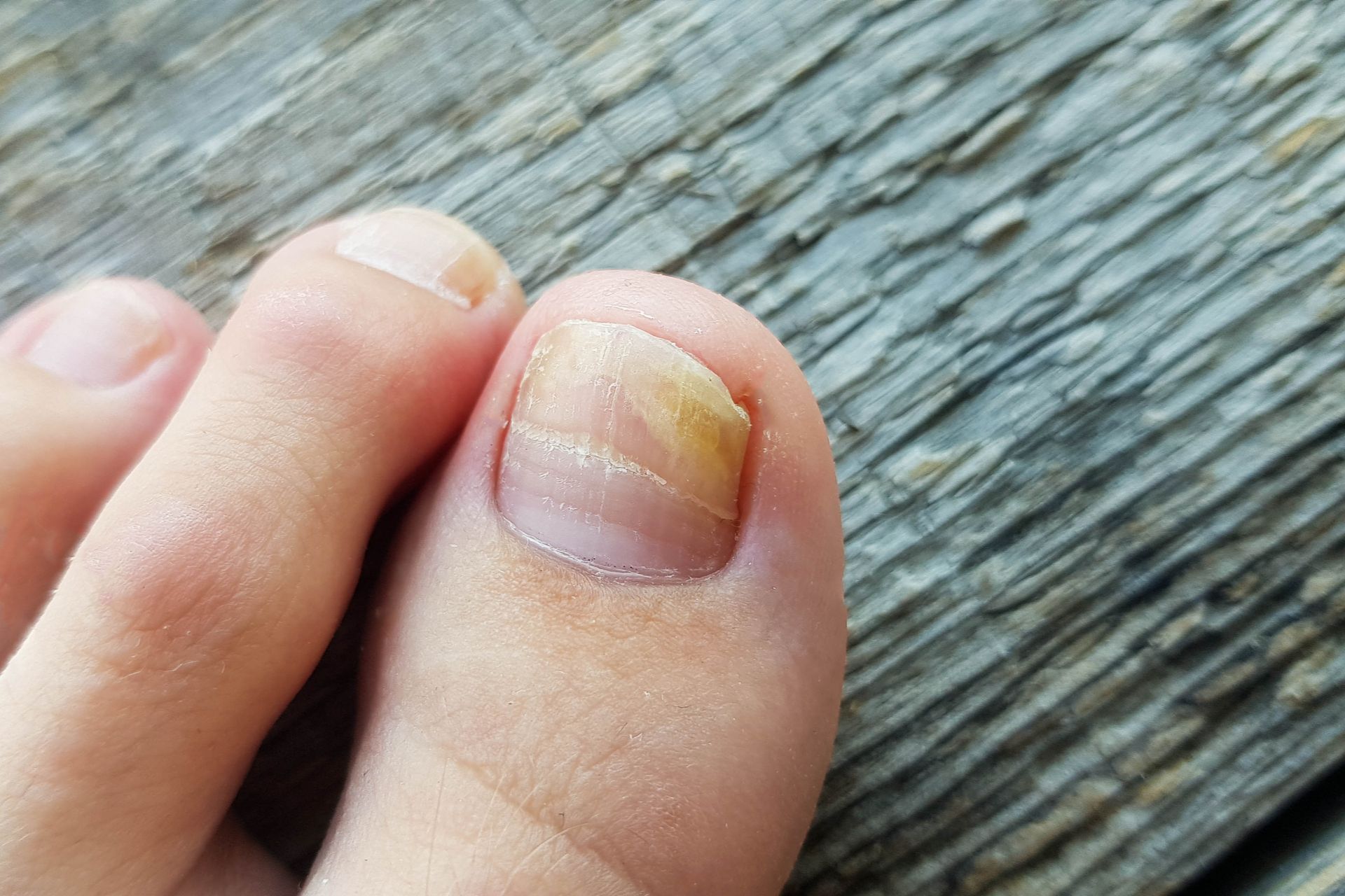 Nagelpilz Ist Ein Haufig Auftretendes Problem Nagelpilz Ist Ein Haufig Auftretendes Problem