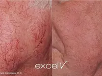Altiderm