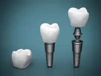 Naturlife Dental Mendrisio - Dr. Bontempelli Lorenzo