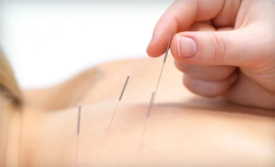 acupuncture