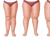 Medical Aesthetic Fettabsaugen Dr. Urs Benz